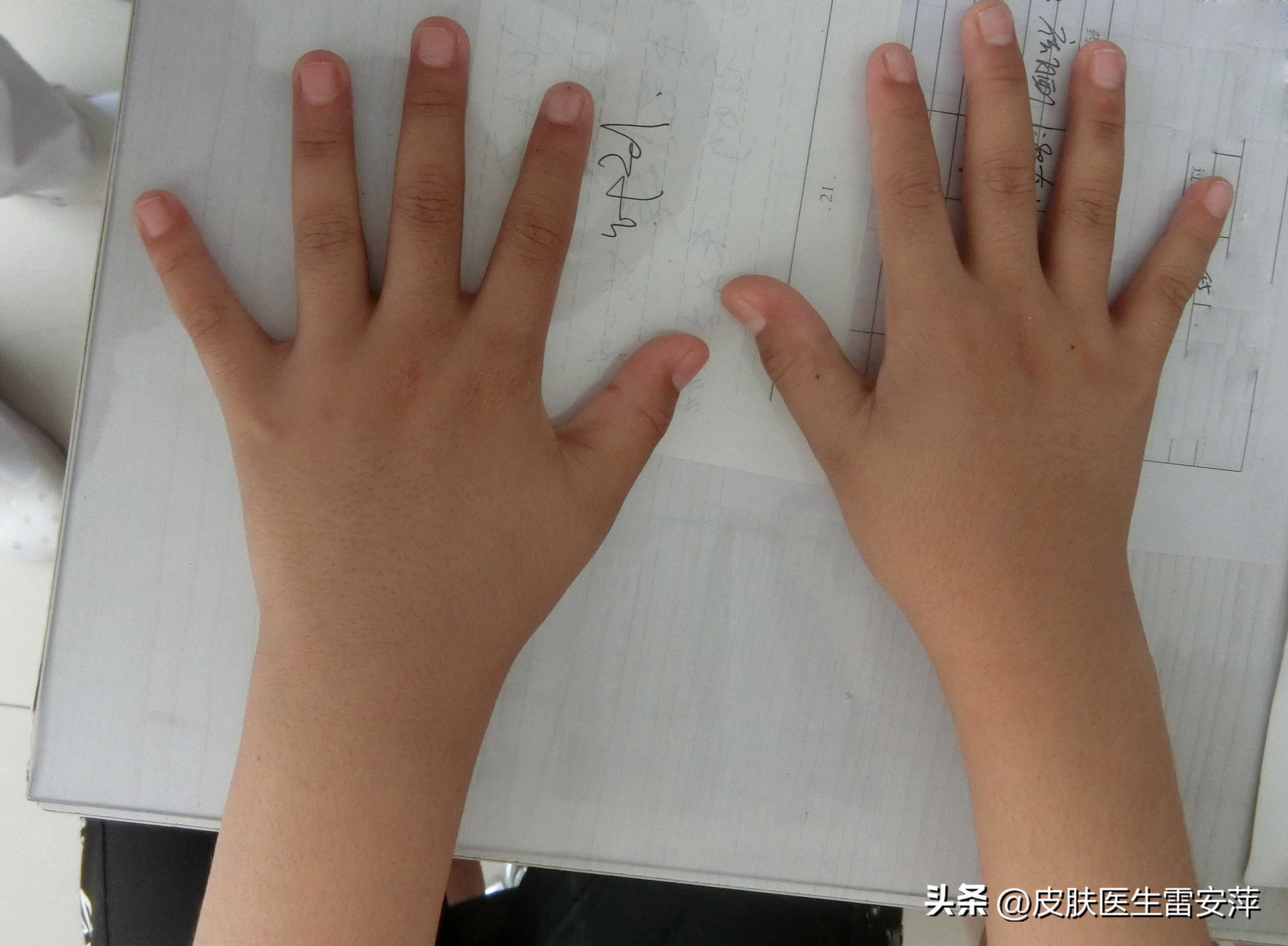 皮肤白癜风怎么遮盖,白癜风手上的白斑是不是最难治疗