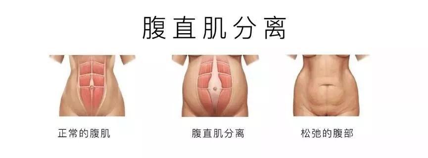 有哪些人建议做产后修复,你们都做产后修复了吗有效果吗