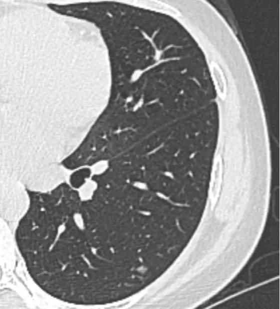 恶性磨玻璃肺结节手术后恢复状况,肺磨玻璃结节术后3年又新发