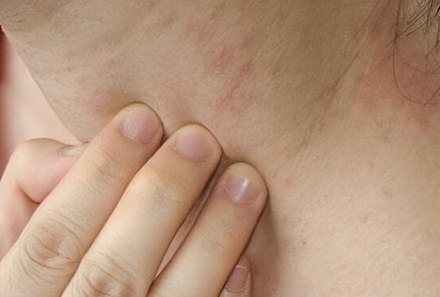 不要错把艾滋病当皮肤病,不要错把艾滋当成皮肤病