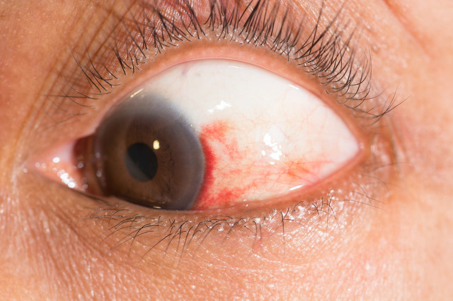 爱护眼睛，老年人如何预防眼底出血呢？医生给出答案