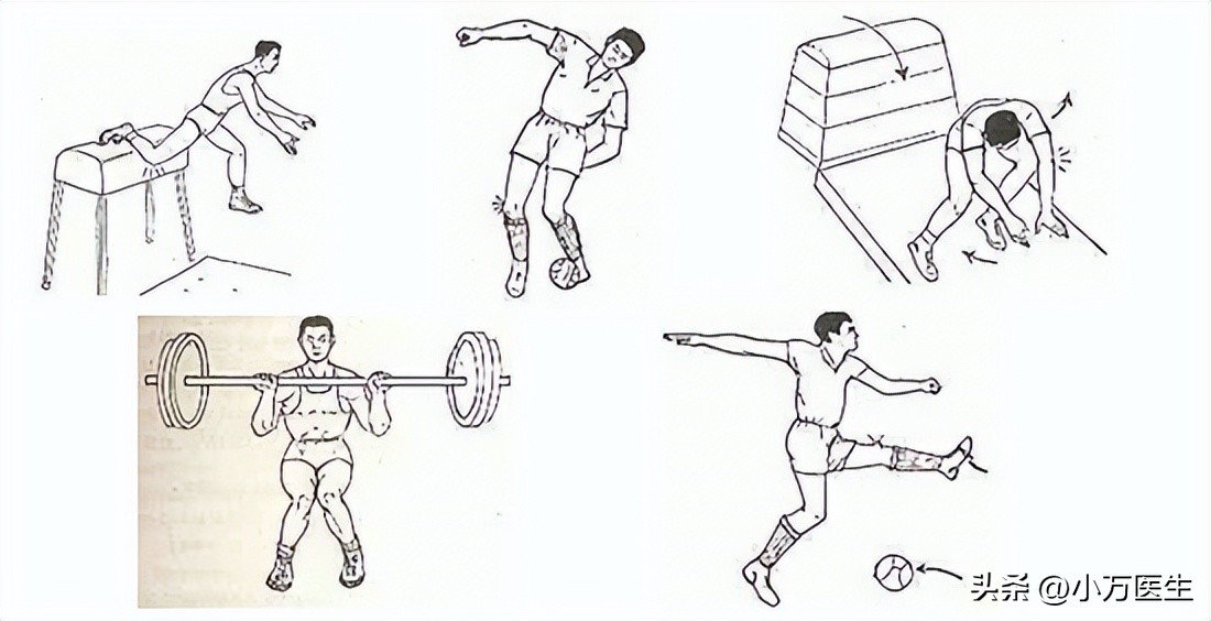 半月板撕裂如何鉴别级数,半月板撕裂分型