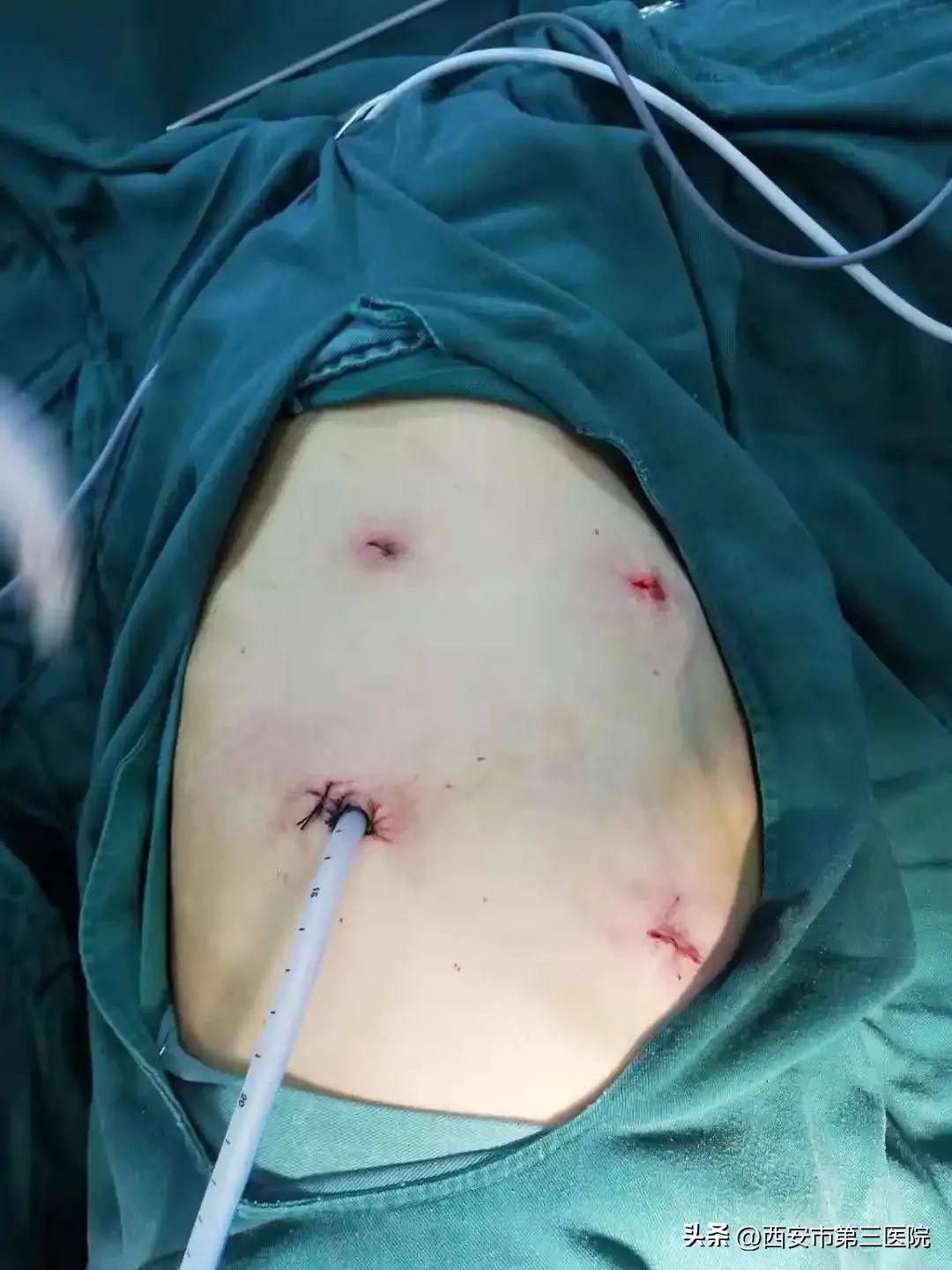 大手术小切口|看腔镜如何治疗食管癌