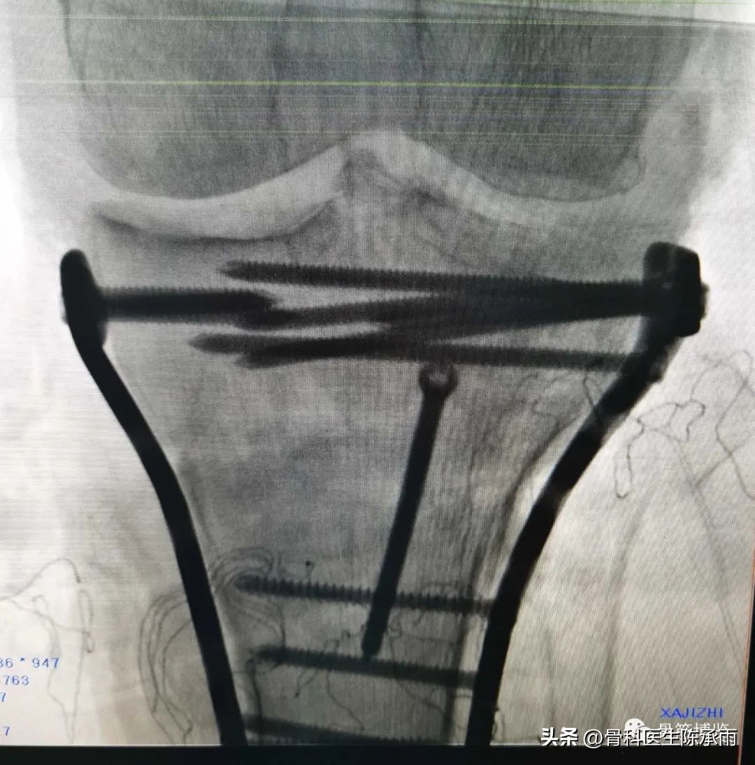 膝关节胫骨平台骨折,最近胫骨平台骨折视频