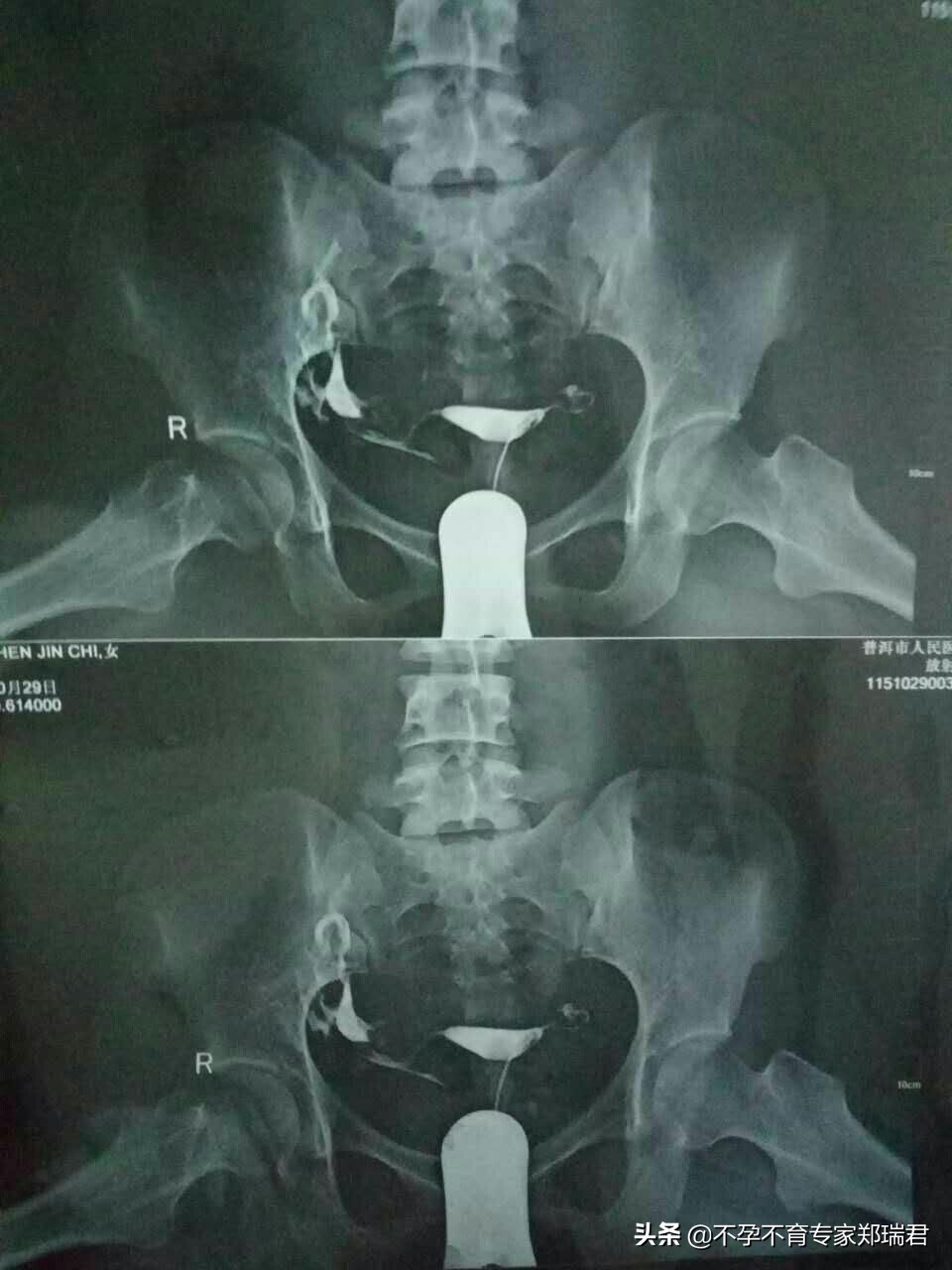 输卵管梗阻做试管,输卵管梗阻试管成功率高吗