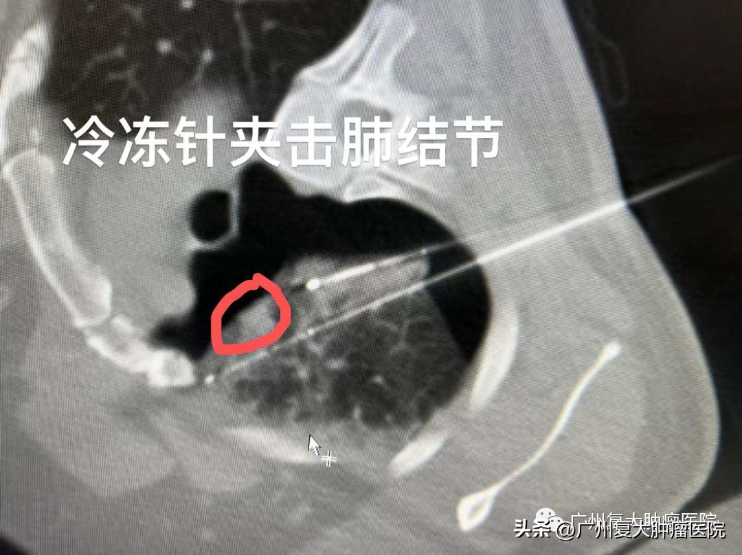 肺结节在内部如何切除,肺气管结节怎么治疗效果最好