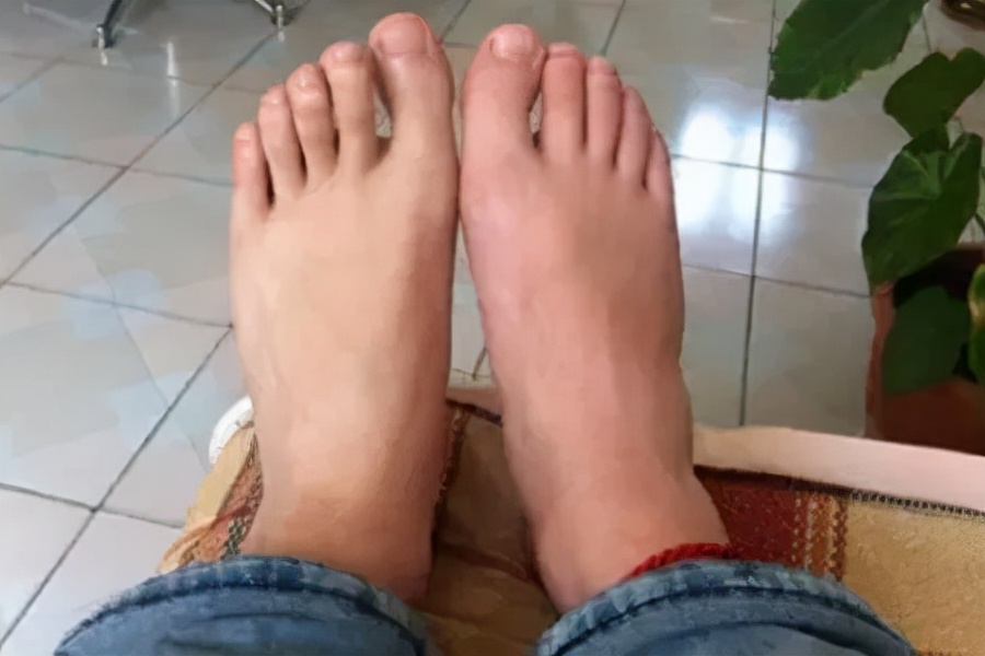 痛风晚上发作没有药怎么快速止痛,痛风经常发作怎么办