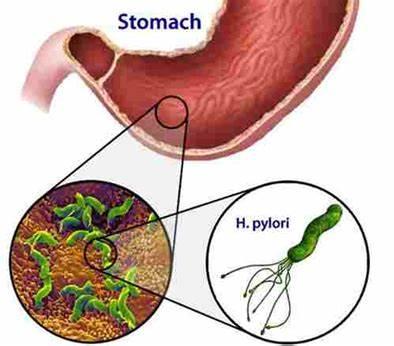 胃胀打嗝口臭,胃胀打嗝打不出嗝口臭