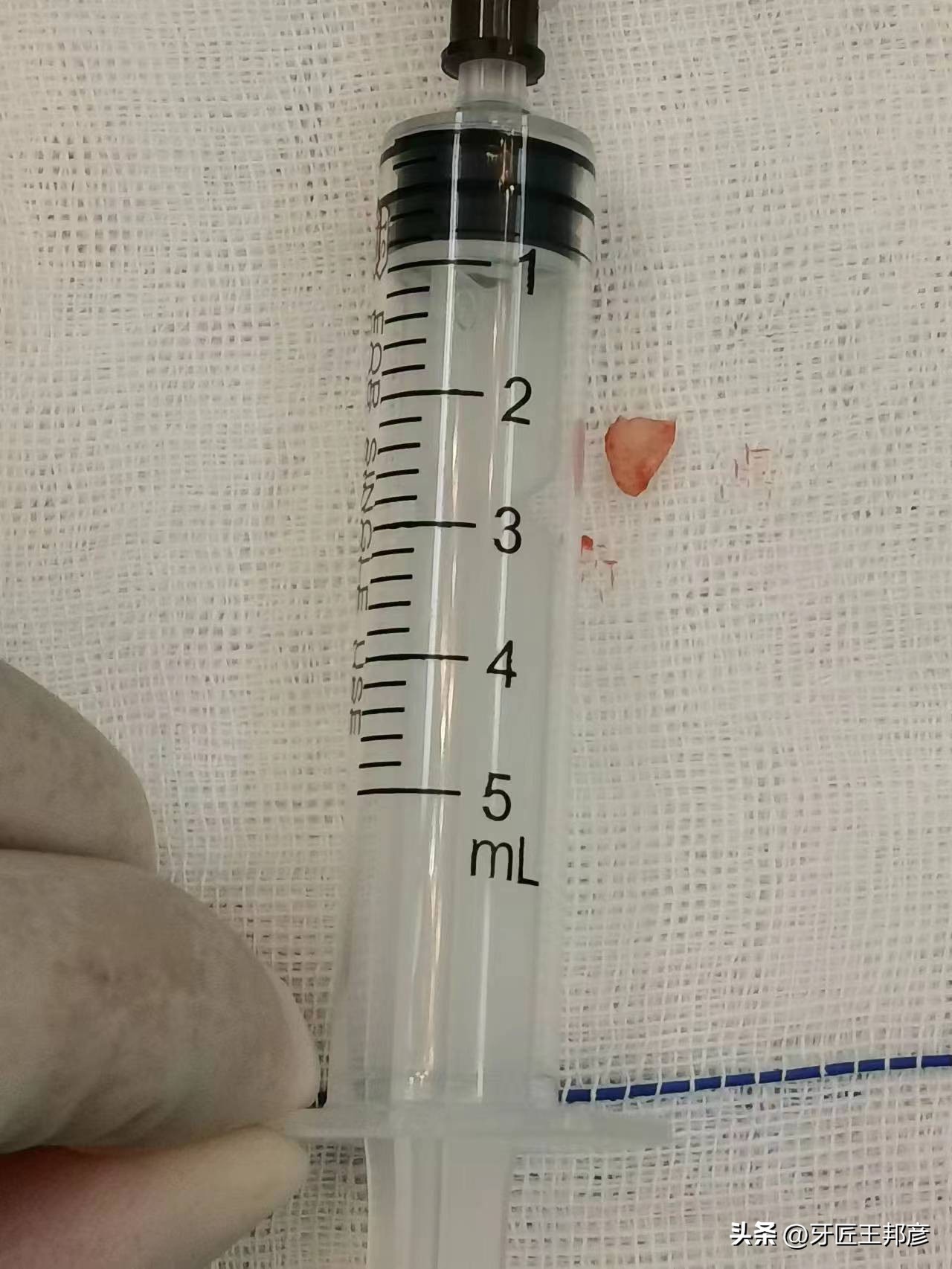 智齿牙根掉入间隙,智齿自己掉了牙根还在里面怎么办