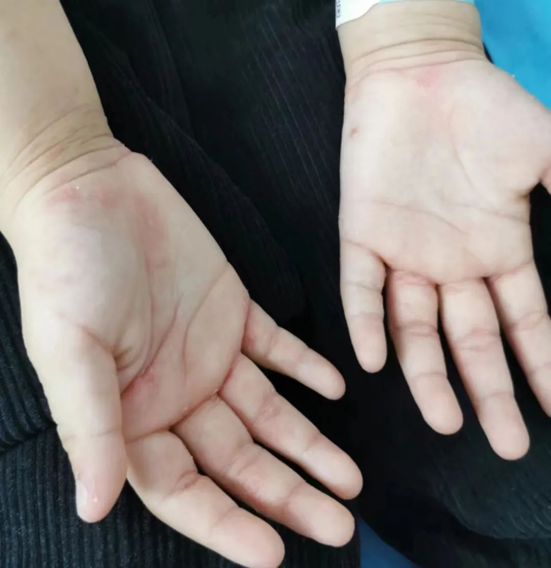 孩子全身痒痒夜间更明显怎么回事,小孩得疥疮为什么抓痒会起一个包