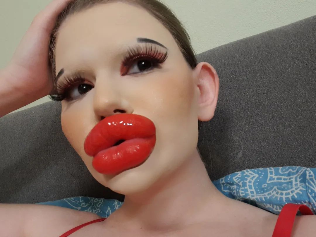 女子狂打30支玻尿酸,丰唇针建议打吗