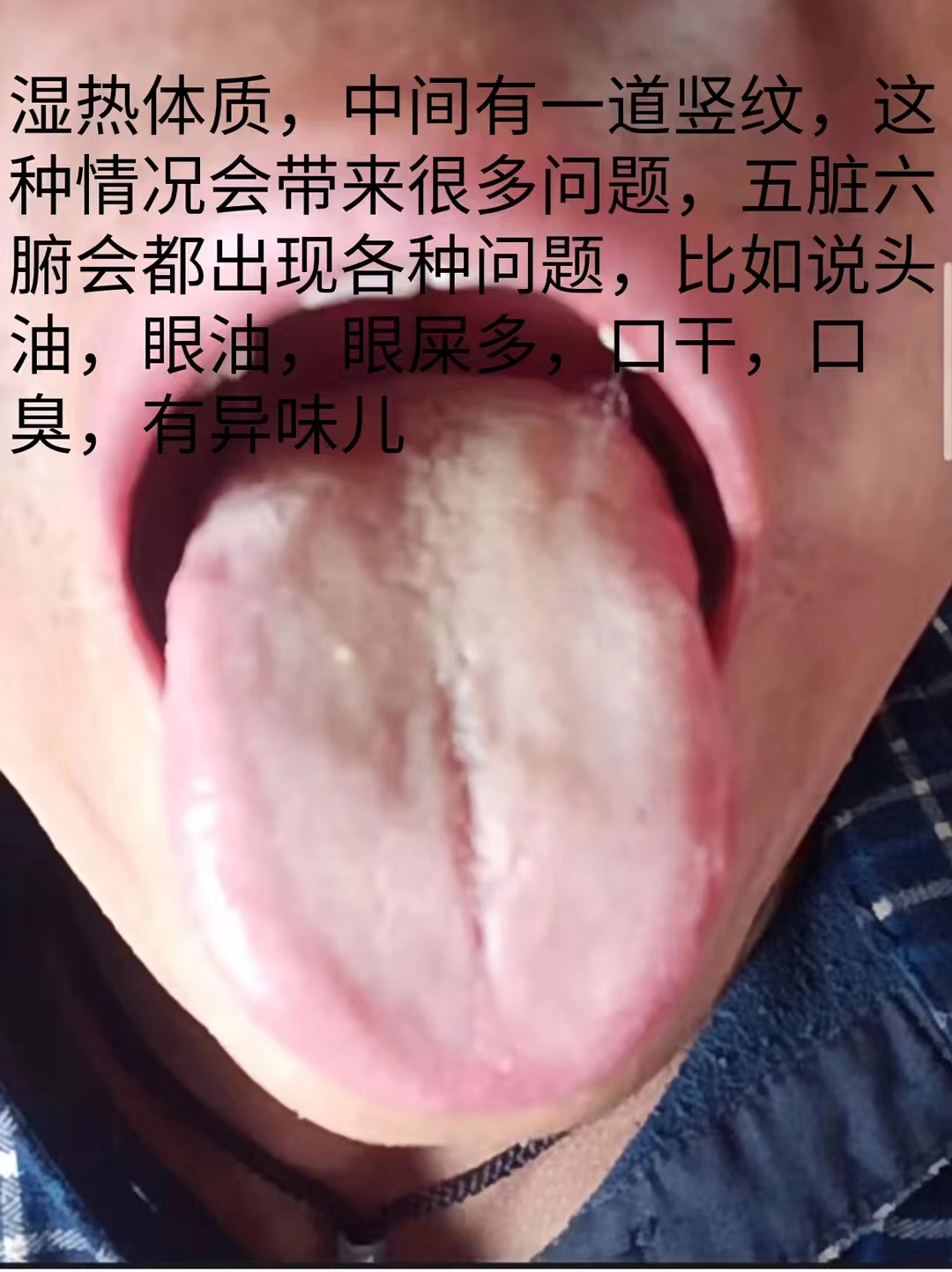 今日舌诊,舌尖舌根凹陷中医辨证