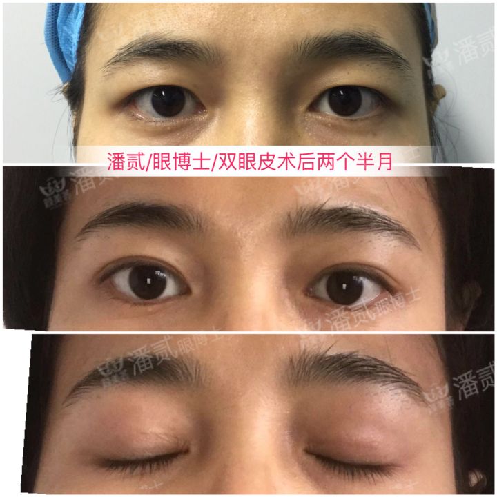 凸眼球显得眼睛大,凸眼眼窝凹陷