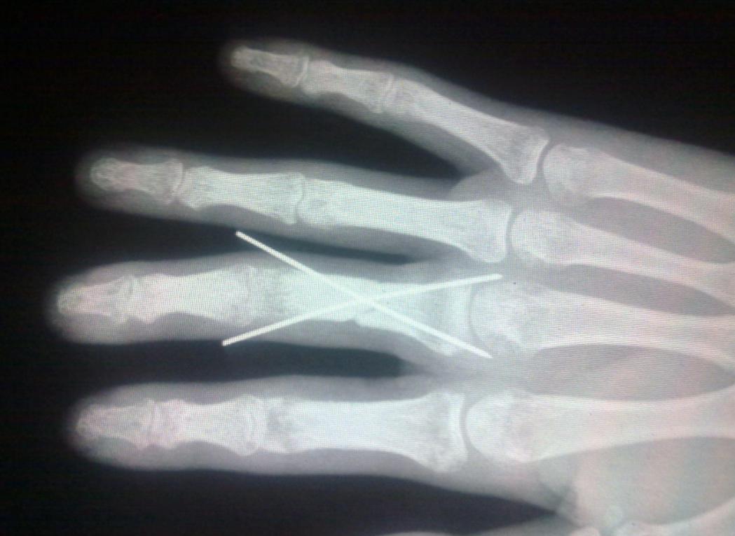 新娘新婚被夹断手指,新娘出嫁被车撞截肢