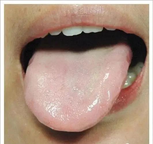 外阴瘙痒外阴炎如何治疗,外阴炎外阴瘙痒怎么治