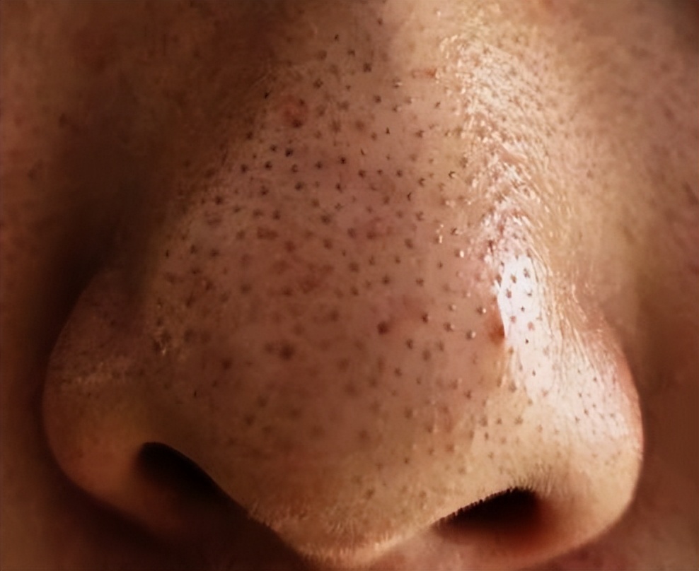 鼻子上油脂粒去除后怎么收缩毛孔,鼻子上长了个类似痘的东西