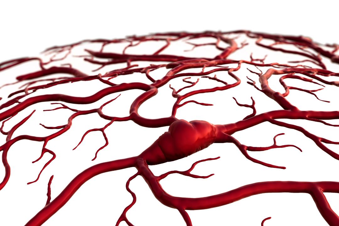 脑动静脉畸形介入手术风险,脑动静脉畸形无症状需要治疗吗