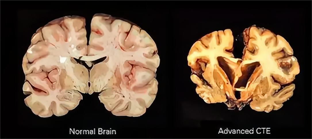 朊病毒防止人类自相残杀,致死率高达100%的病毒