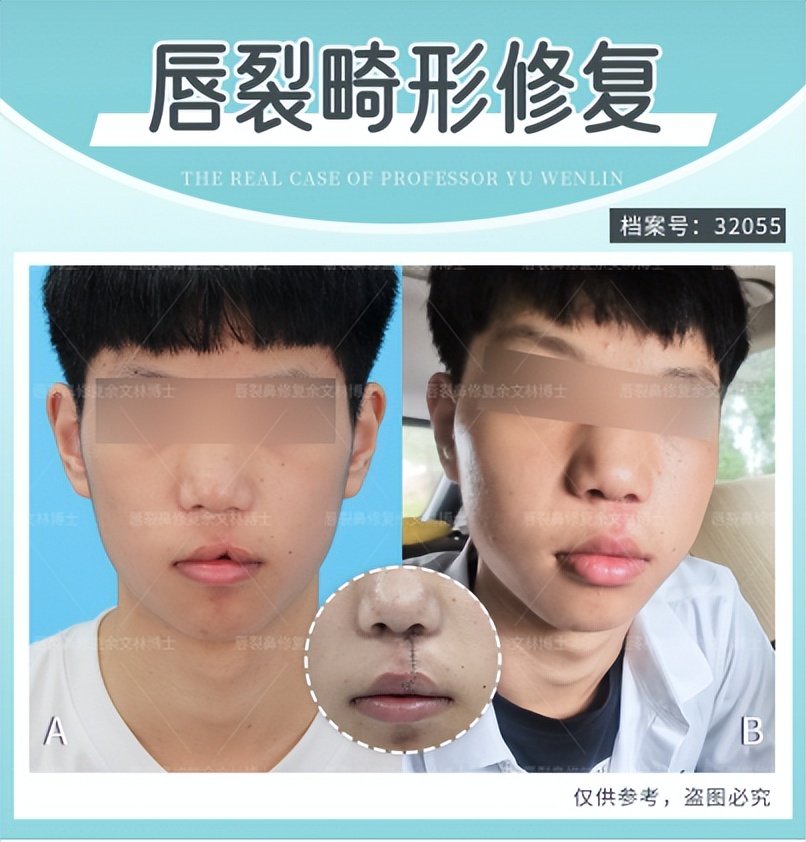 人中沟可以做出来吗,人中能整出来吗