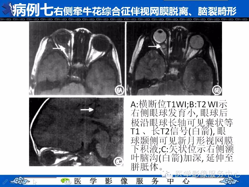 牵牛花综合征可能误诊吗,牵牛花综合征视角
