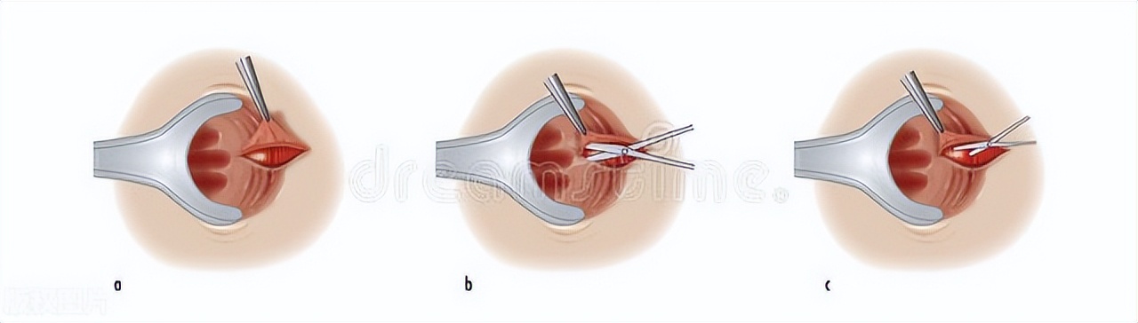 菊花周围潮湿是什么病,女性菊花附近湿疹用什么药
