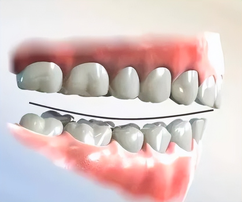 成人深覆合有必要矫正吗,深覆合矫正到一半后悔了