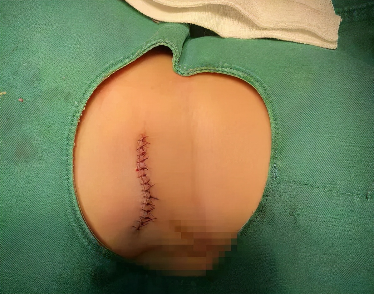 宁晋县医院皮肤科：手术切除“瘢痕”，根治“瘙痒”顽疾