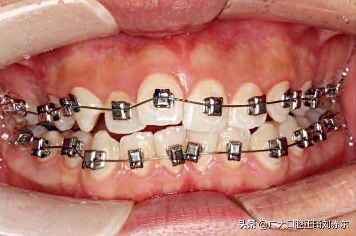 正畸整牙后遗症,正畸并发症