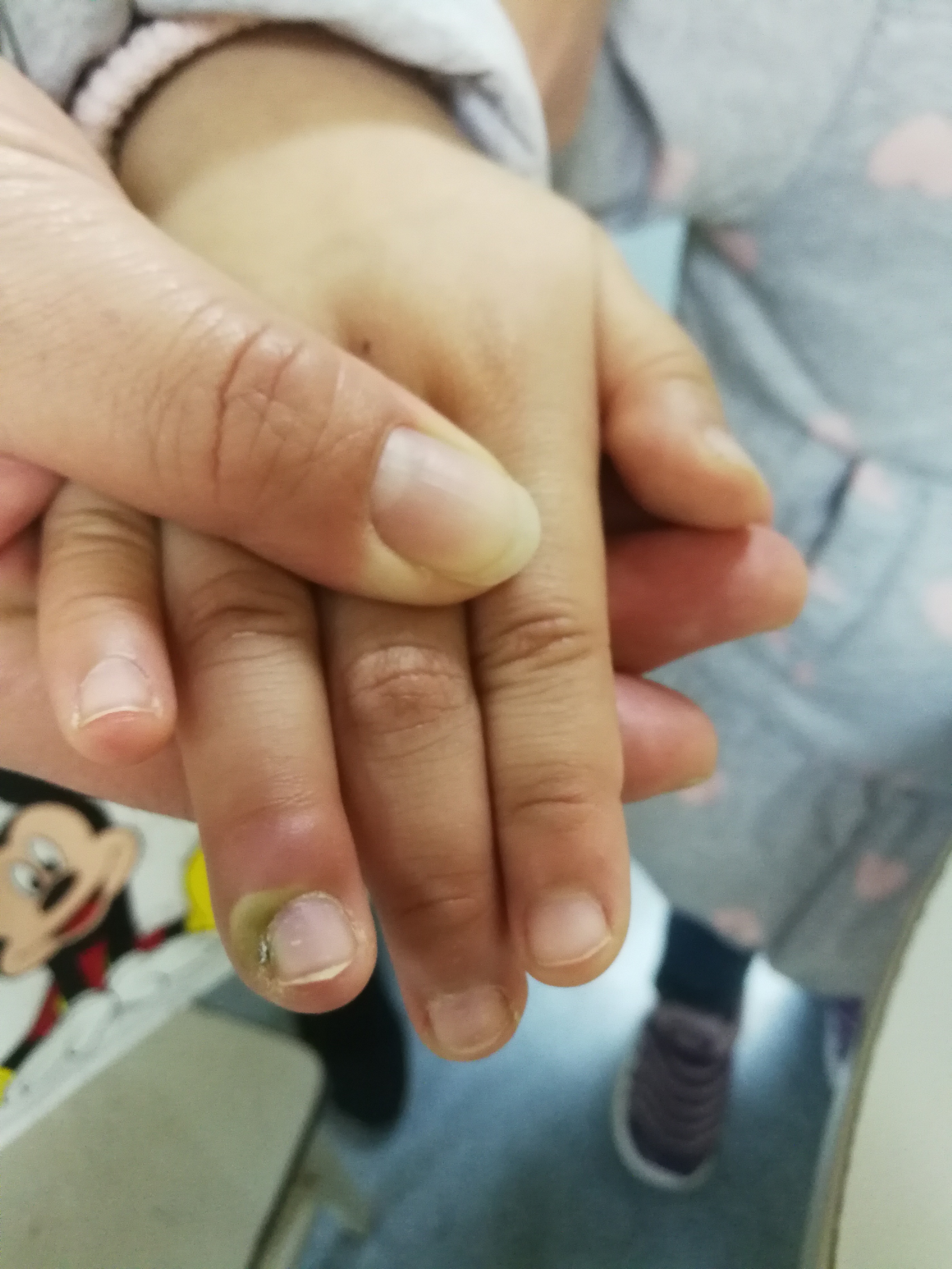 宝宝手指头红肿哭闹,宝宝手指肿胀疼痛是怎么回事