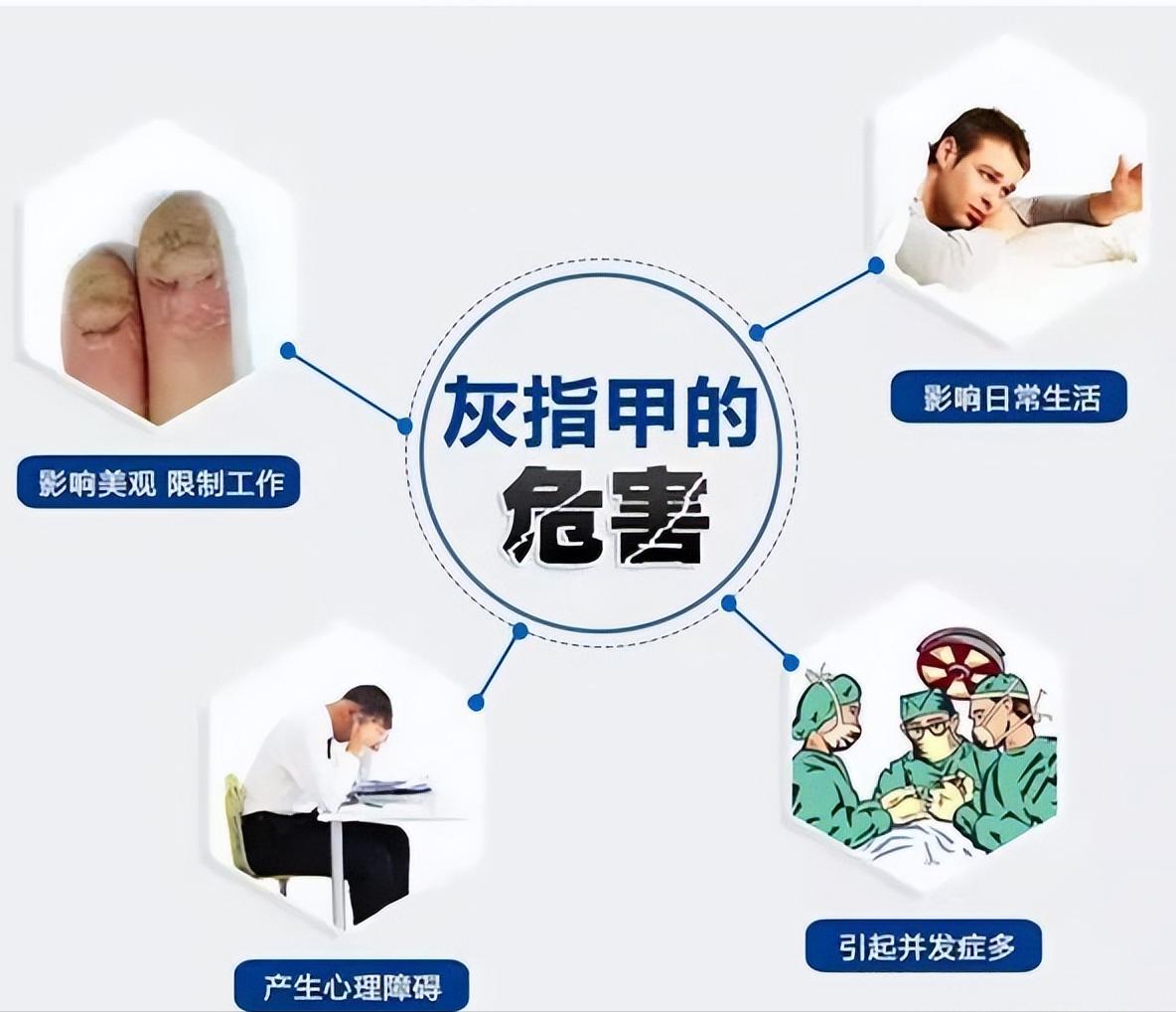 灰甲灵治疗灰指甲效果好吗,灰指甲怎么治疗效果好呢