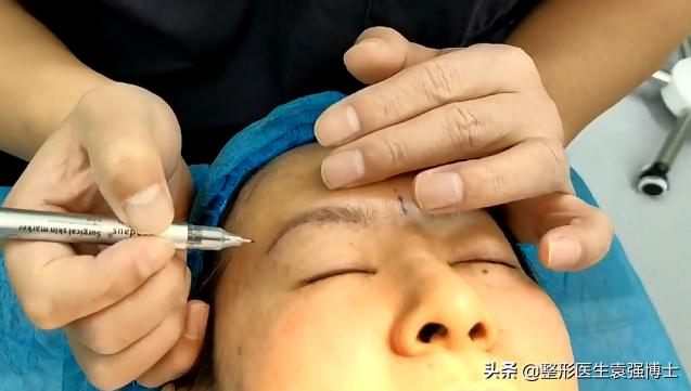 做完提眉后感觉很奇怪,做完提眉疼多久