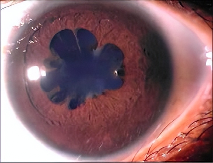 瞳孔分裂成心形是什么症状,瞳孔突然变成三角