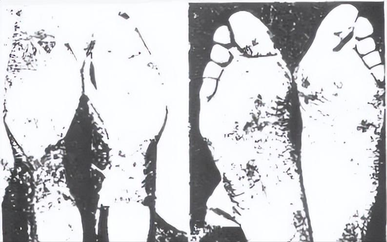 康复师教我怎么矫正扁平足,扁平足十大康复训练