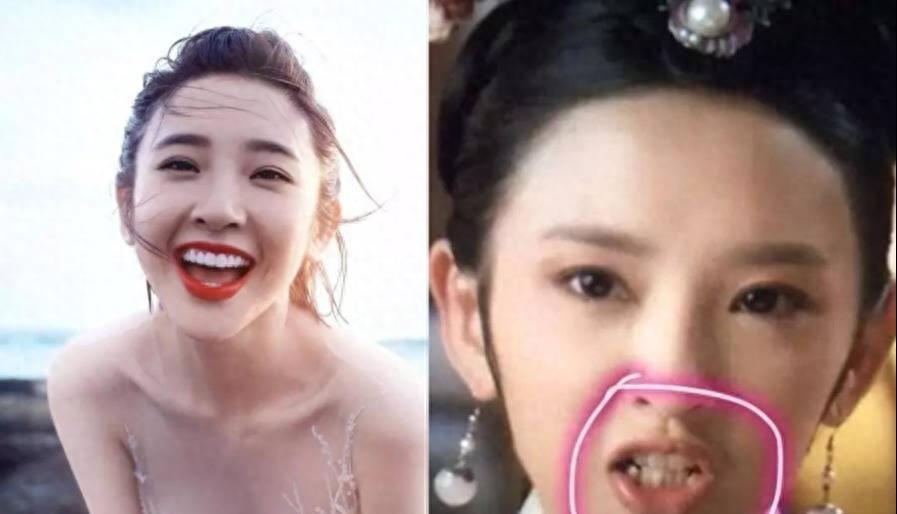 明星烤瓷牙发黑,明星烤瓷牙牙齿磨小后照片