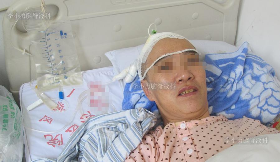 脑积水手术后4天还呕吐怎么回事,脑积水分流术后一直腹部疼痛