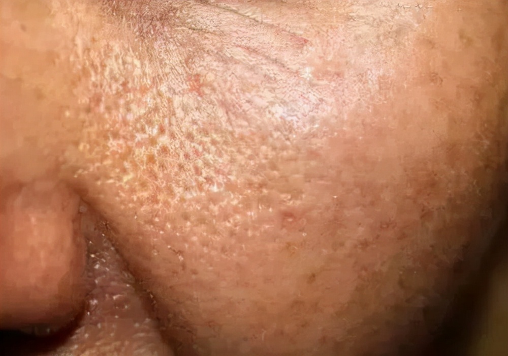 毛孔粗大和毛孔不粗大对比,毛孔粗大到底怎么样才能收缩毛孔