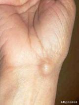 14岁学霸患癌症,2019年安徽学霸患癌