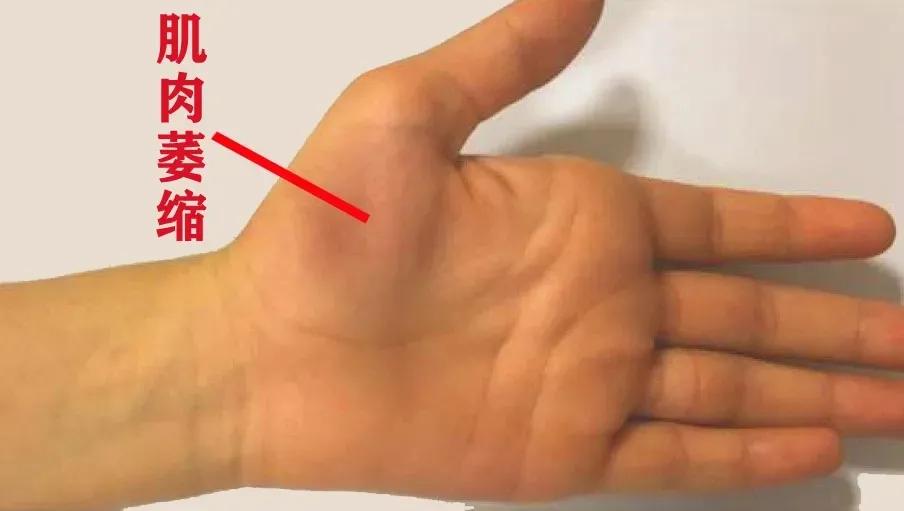 急性腕管综合征引起手腕痛怎么治,手腕管痛综合征治疗方法