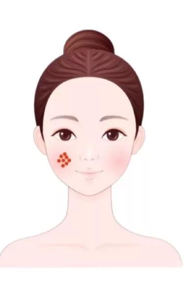 脸上有痘生活小妙招,你有什么方法改善脸上的痘痘