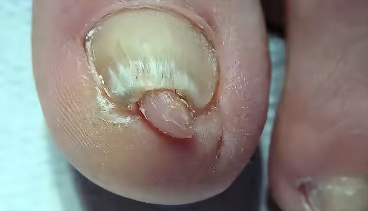 脚趾头一碰到就很疼怎么治,脚趾头走路疼捏着不疼是咋回事