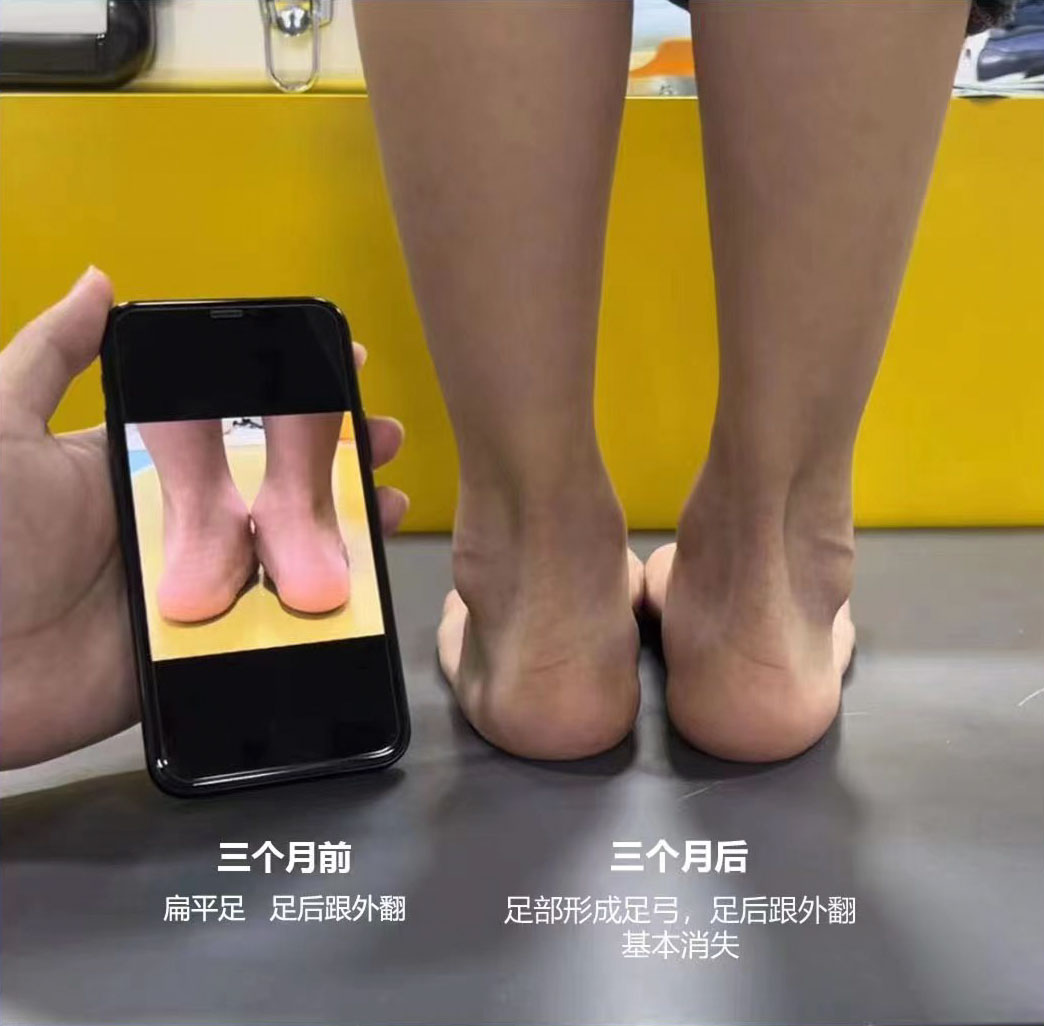 改善腿型让腿变直的鞋,腿不直穿什么鞋子掩盖缺陷