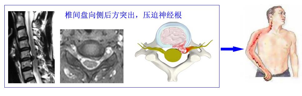 颈椎病是什么病要怎么治,颈椎病是怎样的症状