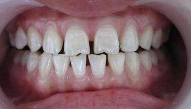 牙齿地包天导致骨头严重畸形,牙齿畸形缺失地包天怎么办