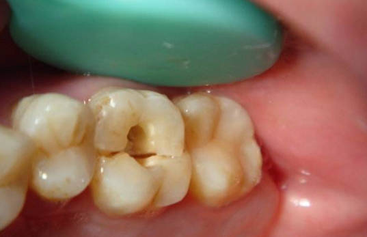 做了根管治疗的牙又开始痛了,牙做了根管治疗为啥还疼