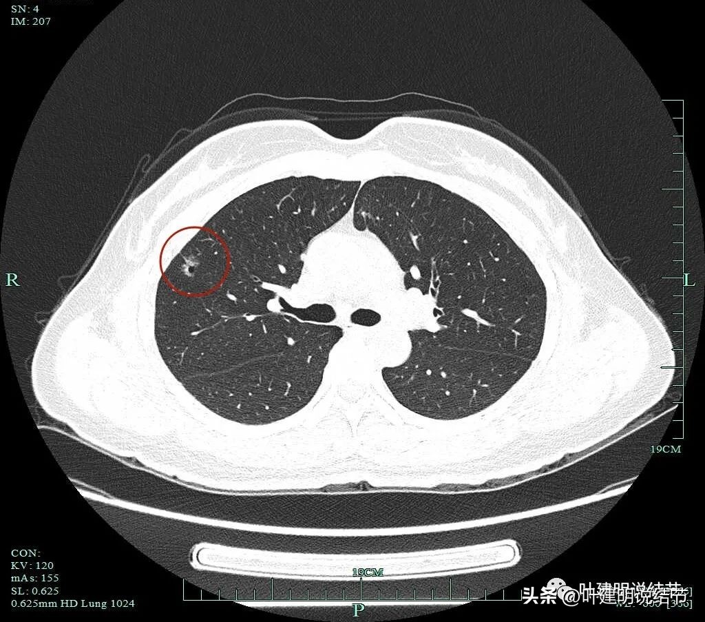 磨玻璃结节伴有增生是癌症吗,磨玻璃结节会是别的癌转移的吗