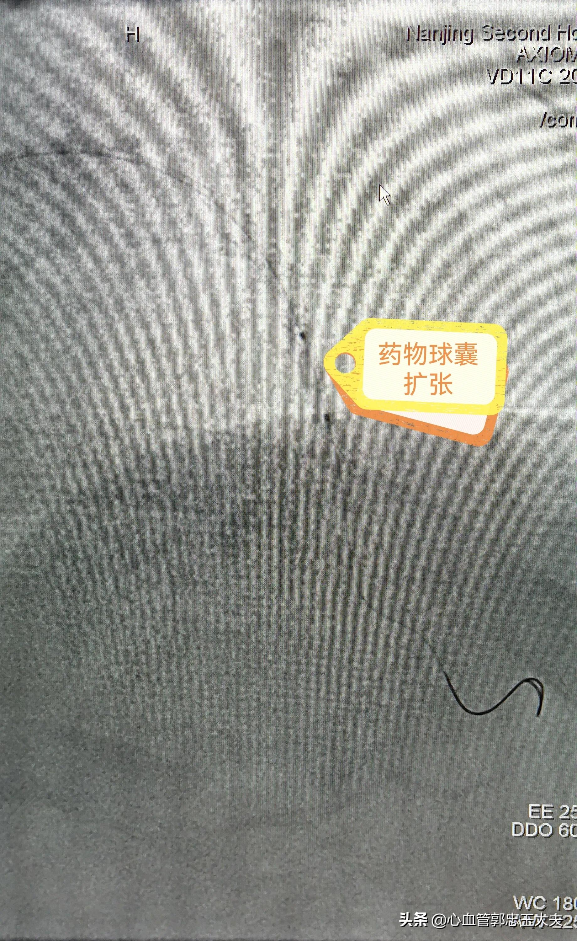 为什么支架内更容易堵,指标正常但支架内再狭窄