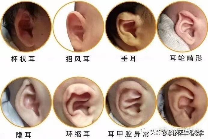 为什么会导致小耳畸形,大小耳畸形有遗传吗