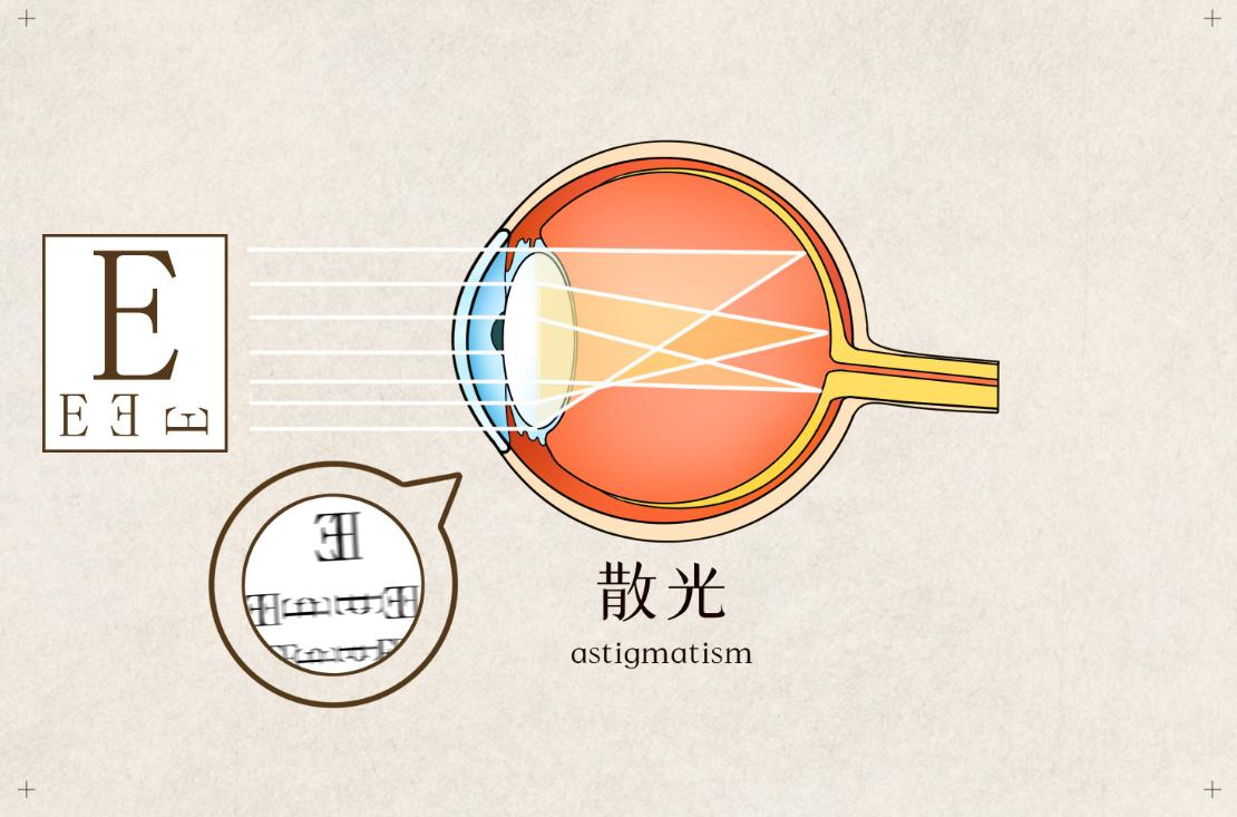 成年后散光增加的原因,眼睛散光增加怎么回事