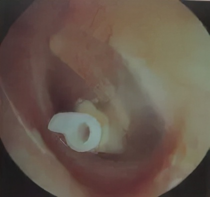 分泌性中耳炎可以吃耳聋通窍丸吗,儿童中耳炎鼓膜内陷耳鸣