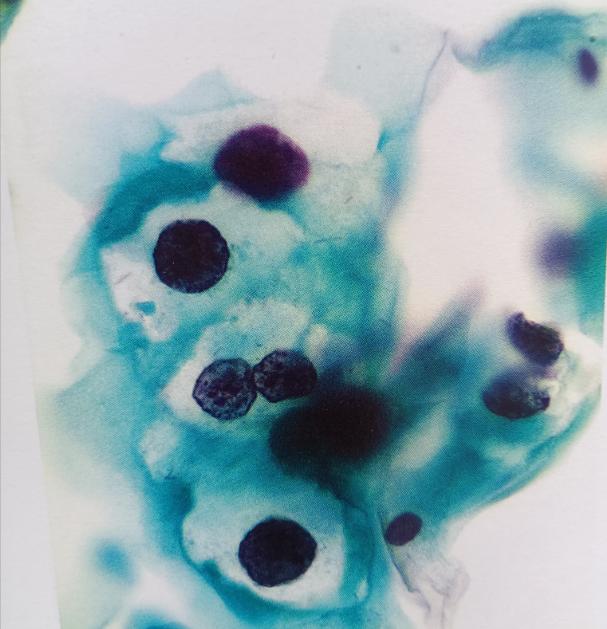 HPV感染和宫颈癌的预防与早期发现